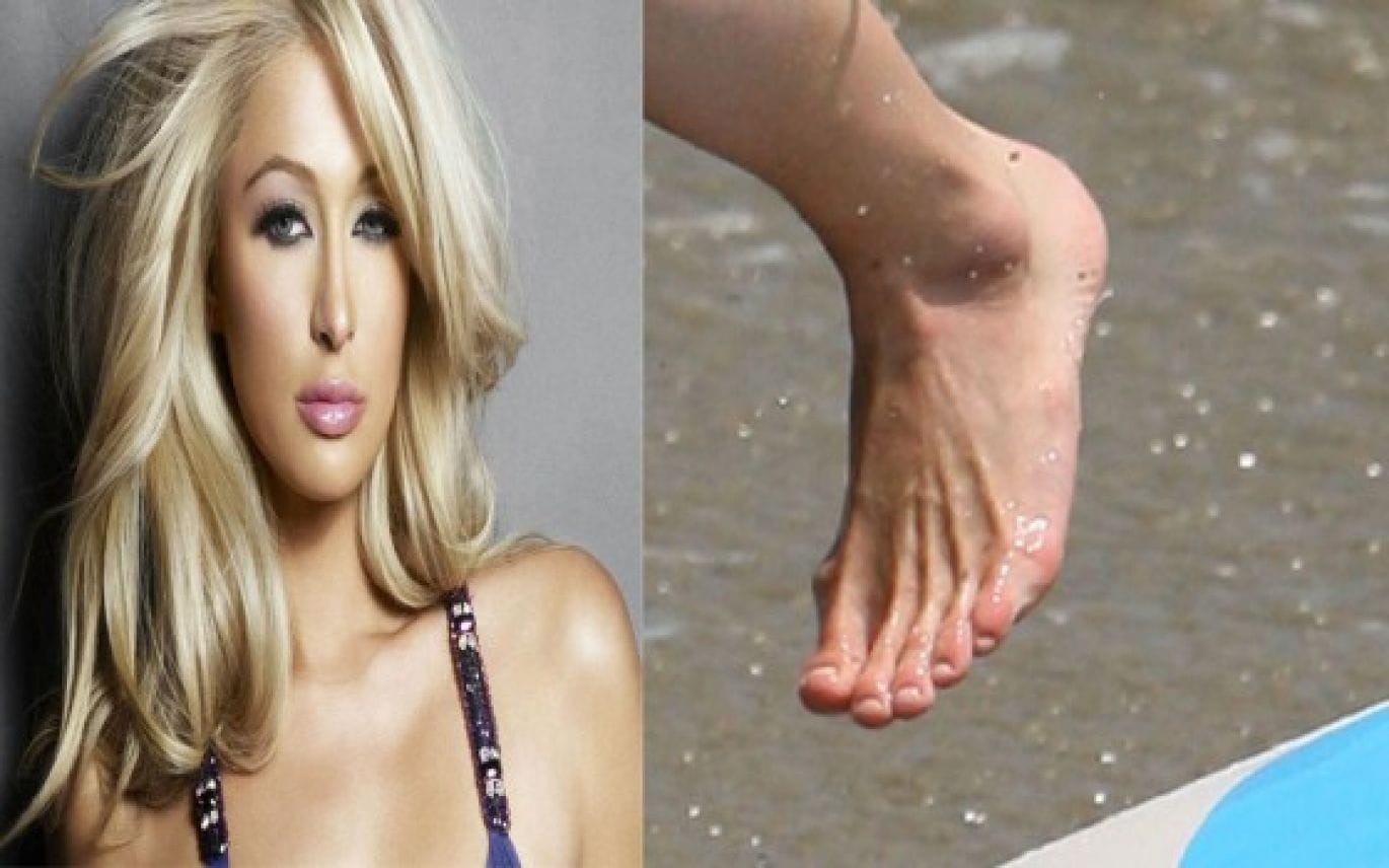 8 Prettiest Celebs With Ugliest Legs Genmice